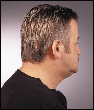 After prosthetic hair